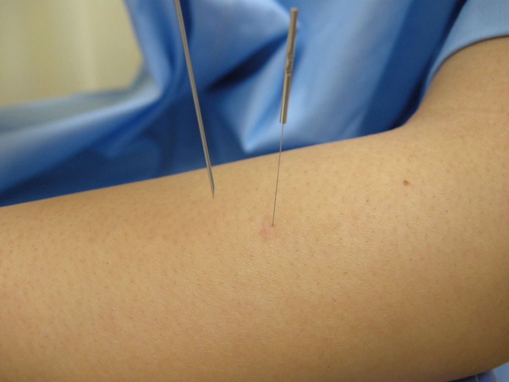 左が注射針、右が鍼治療の鍼で太さが全く違います